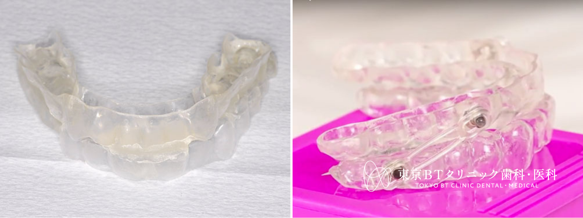 睡眠時無呼吸症候群用マウスピースの種類と選び方