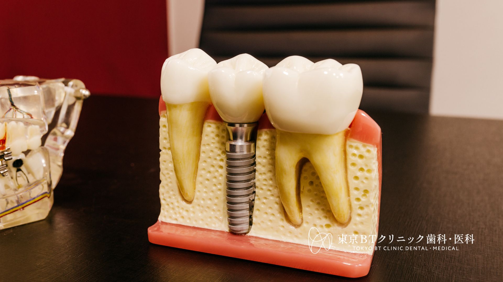 インプラント 骨が少ない方への治療法｜PRGF併用の上顎洞底挙上術とは
