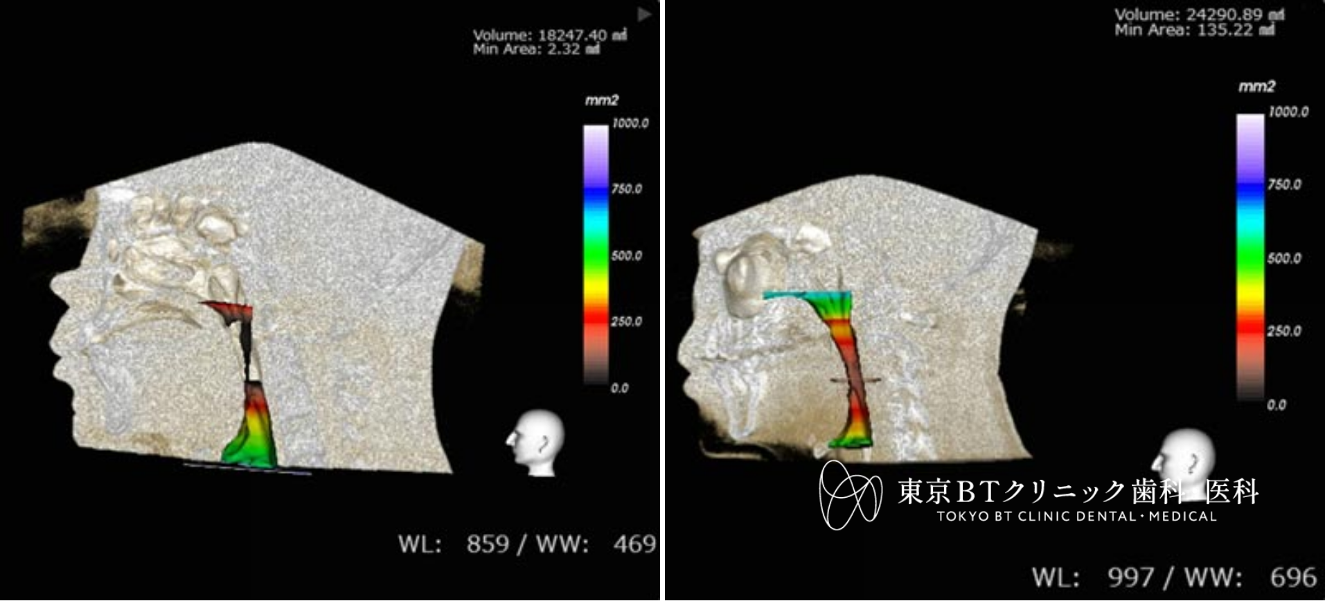 マウスピースで歯ぎしりと無呼吸を同時改善|効果と選び方を専門医が解説