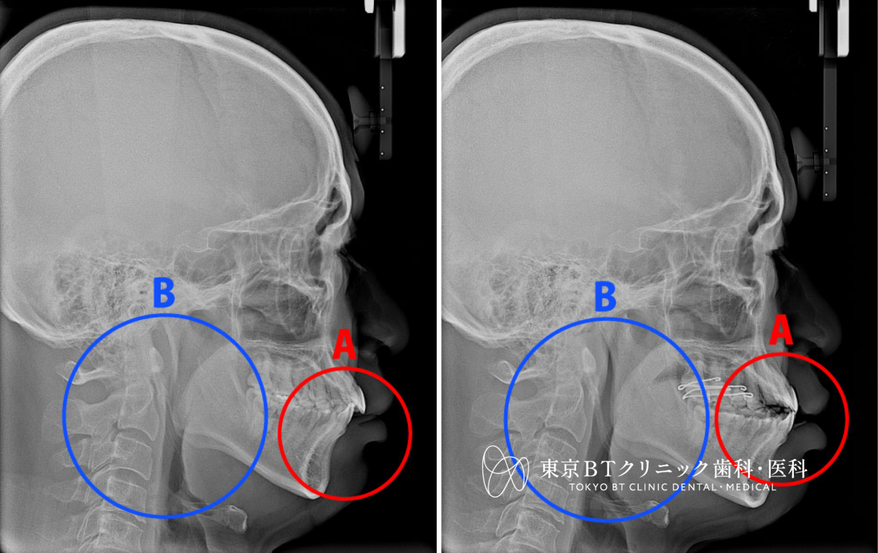 いびきのマウスピース治療の効果と費用|CPAP不要の睡眠時無呼吸対策